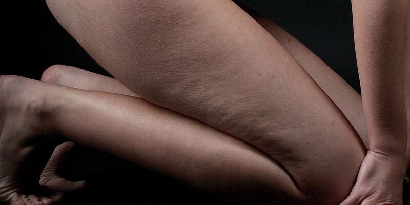 Culotte de cheval: cos’è, cause e come combatterla